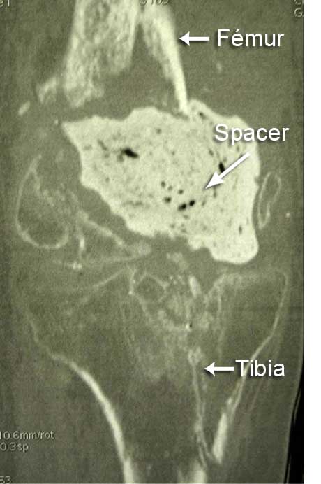 Aspect à au scanner du genou du patient, avec le spacer qui comblait la perte de substance osseuse et qui était infecté