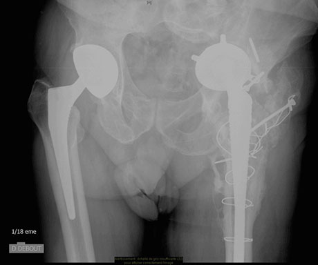 Radiographie du bassin de face en préopératoire