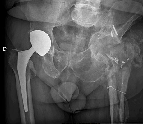 Radiographie du bassin de face en postopératoire