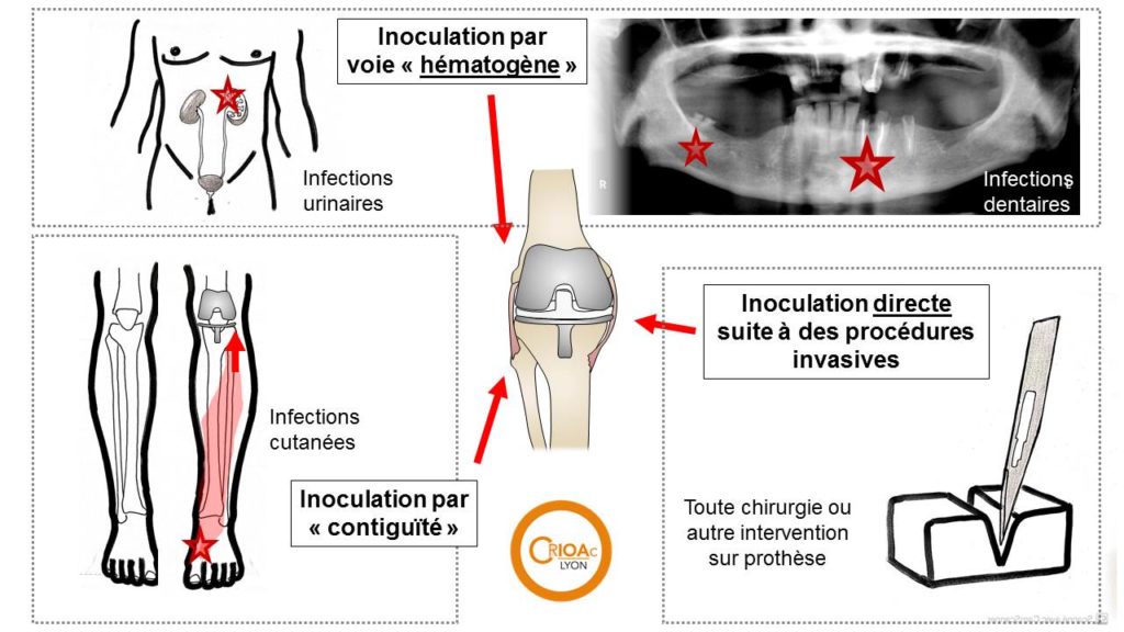 CRIOAc Lyon What is a bone and joint infection?