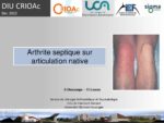 Les arthrites septiques sur articulation native