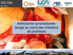 Arthrotomie-synovectomie-lavage au cours des infections de prothèse