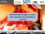 Arthrotomie-lavage au cours des infections de prothèses à S. aureus