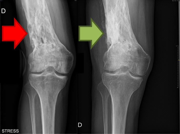 Radiographies du genou montrant l'ostéomyélite du fémur avant et après le curetage et l'administration du substitut osseux à la gentamicine